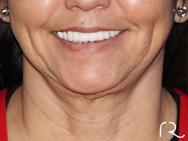 Facelift Before & After Gallery - Patient 143289810 - Image 3
