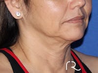 Neck Lift Before & After Gallery - Patient 143289783 - Image 1