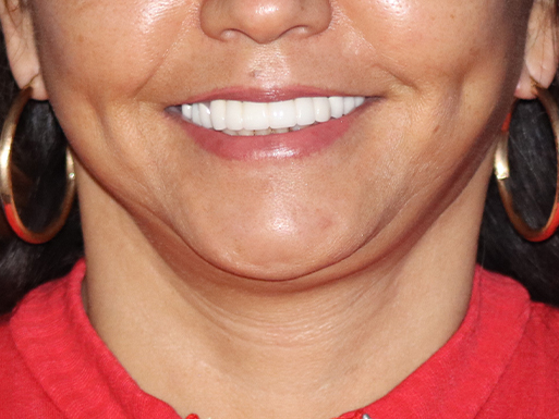 Facelift Before & After Gallery - Patient 143289810 - Image 4