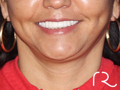 Facelift Before & After Gallery - Patient 143289810 - Image 4