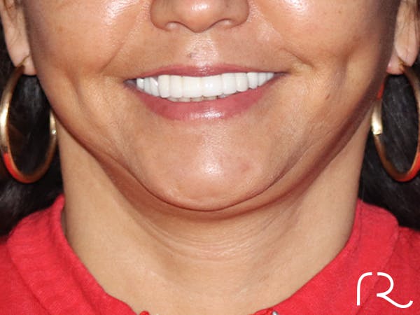 Neck Lift Before & After Gallery - Patient 143289783 - Image 4