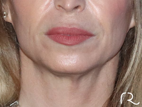 Facelift Before & After Gallery - Patient 165758 - Image 1
