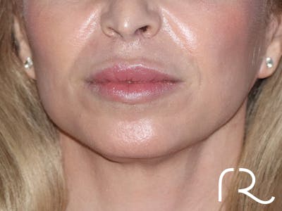 Facelift Before & After Gallery - Patient 165758 - Image 2