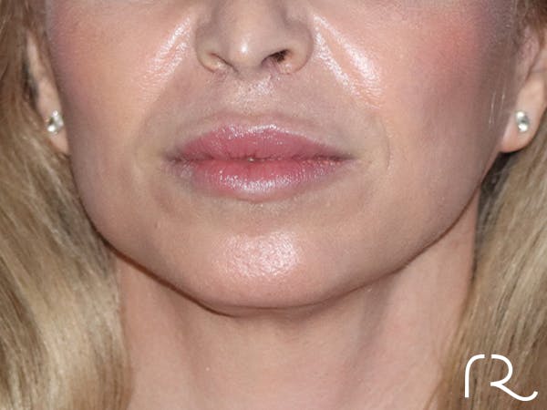 Facelift Before & After Gallery - Patient 165758 - Image 2