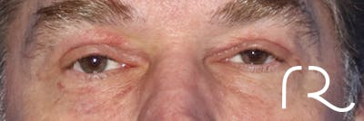 Eyelid Surgery Before & After Gallery - Patient 143289889 - Image 2