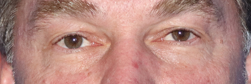 Eyelid Surgery Before & After Gallery - Patient 143289889 - Image 1