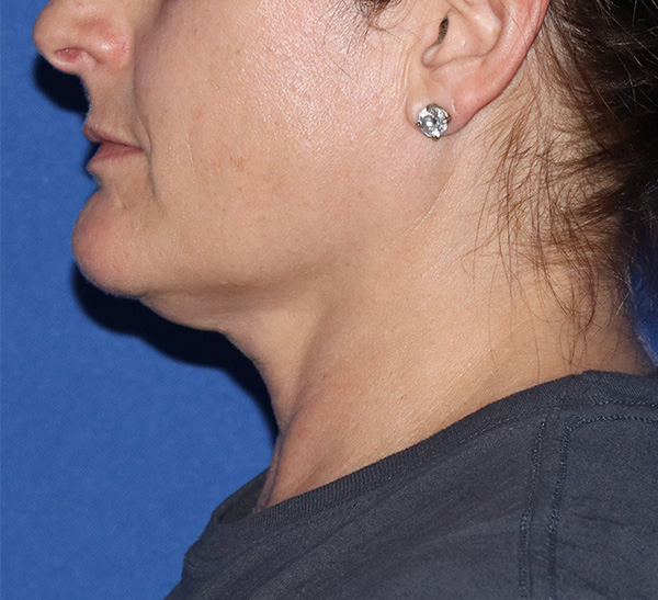 Neck Liposuction  Before & After Gallery - Patient 146149659 - Image 1