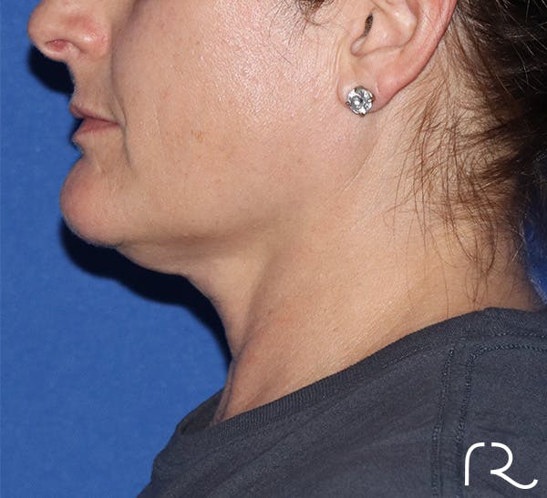 Neck Liposuction  Before & After Gallery - Patient 146149659 - Image 1
