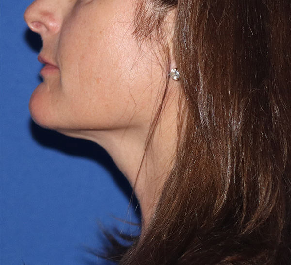 Neck Liposuction  Before & After Gallery - Patient 146149659 - Image 2