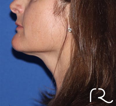 Neck Liposuction  Before & After Gallery - Patient 146149659 - Image 2