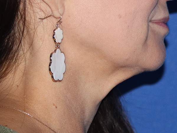 Neck Lift Before & After Gallery - Patient 146149664 - Image 1