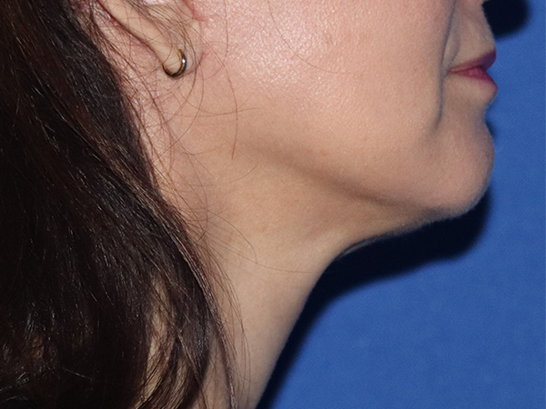 Facelift Before & After Gallery - Patient 146149687 - Image 2