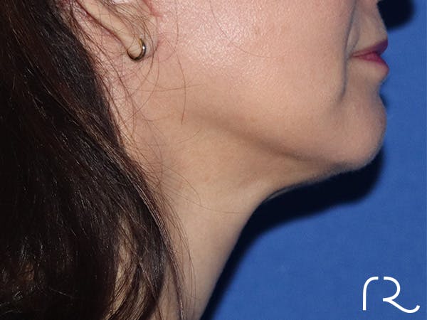 Neck Lift Before & After Gallery - Patient 146149664 - Image 2