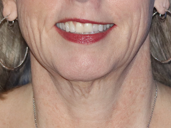 Neck Lift Before & After Gallery - Patient 146149667 - Image 1
