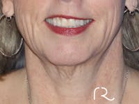 Neck Lift Before & After Gallery - Patient 146149667 - Image 1