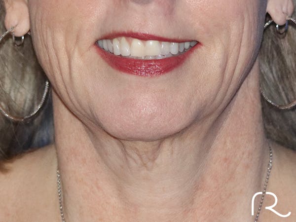 Facelift Before & After Gallery - Patient 146149686 - Image 1