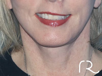 Neck Lift Before & After Gallery - Patient 146149667 - Image 2
