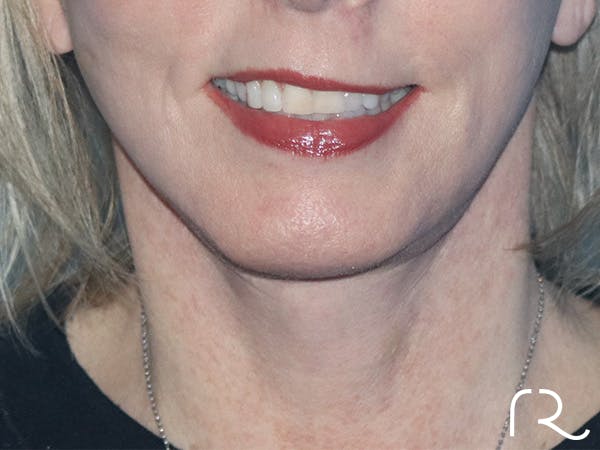 Facelift Before & After Gallery - Patient 146149686 - Image 2