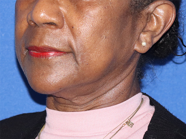 Neck Lift Before & After Gallery - Patient 146149680 - Image 1