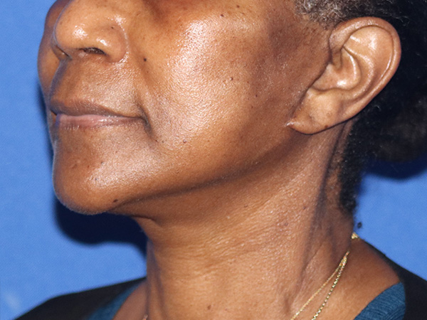 Neck Lift Before & After Gallery - Patient 146149680 - Image 2