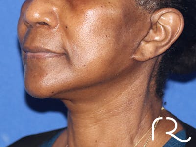 Facelift Before & After Gallery - Patient 146149685 - Image 2