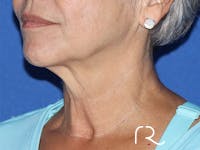 Facelift Before & After Gallery - Patient 146149684 - Image 1