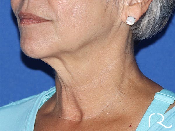 Neck Lift Before & After Gallery - Patient 146149679 - Image 1