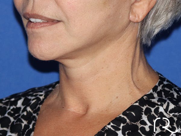 Facelift Before & After Gallery - Patient 146149684 - Image 2