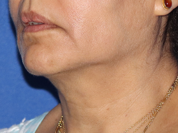 Neck Lift Before & After Gallery - Patient 146149678 - Image 1