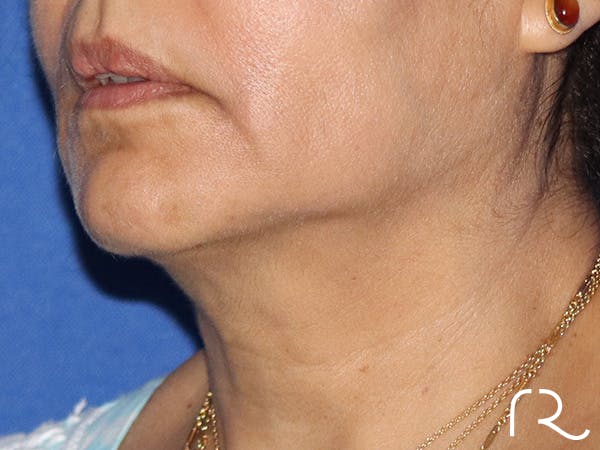 Neck Lift Before & After Gallery - Patient 146149678 - Image 1