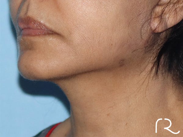 Neck Lift Before & After Gallery - Patient 146149678 - Image 2
