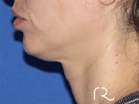 Facelift Before & After Gallery - Patient 146149682 - Image 1