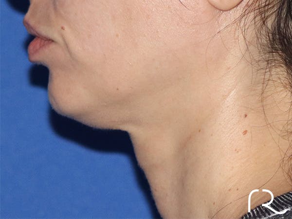 Neck Lift Before & After Gallery - Patient 146149677 - Image 1
