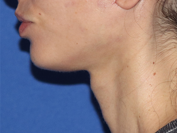 Neck Lift Before & After Gallery - Patient 146149677 - Image 2