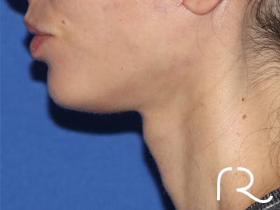 Facelift Before & After Gallery - Patient 146149682 - Image 2