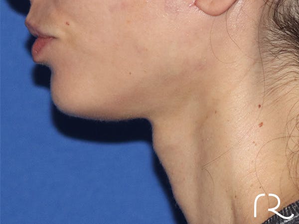 Neck Lift Before & After Gallery - Patient 146149677 - Image 2