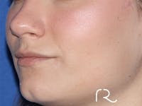 Rhinoplasty Before & After Gallery - Patient 146149735 - Image 1