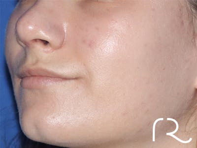 Rhinoplasty Before & After Gallery - Patient 146149735 - Image 2