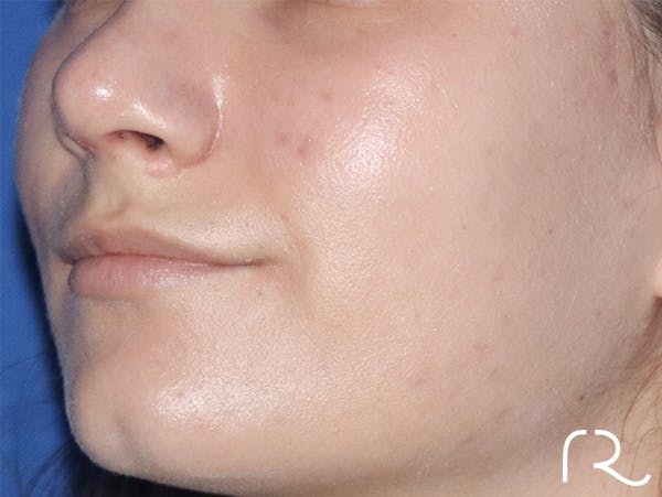 Rhinoplasty Before & After Gallery - Patient 146149735 - Image 2