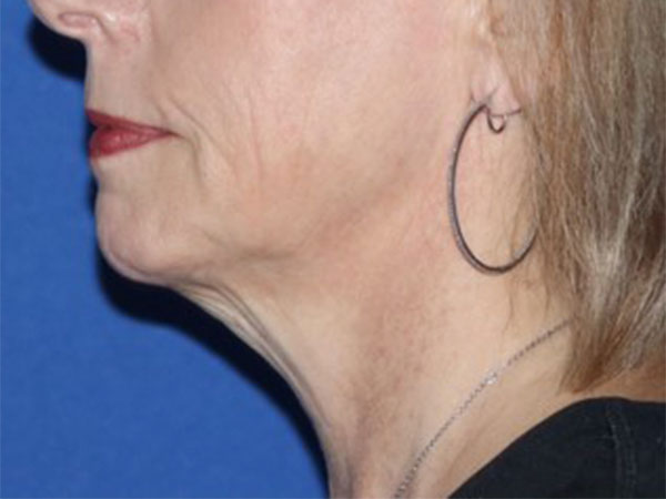 R2 Extended Deep Neck Lift Before & After Gallery - Patient 146377528 - Image 1