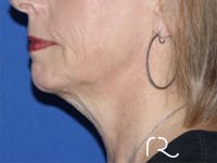 Extended Deep Neck Lift Before & After Gallery - Patient 146377528 - Image 1