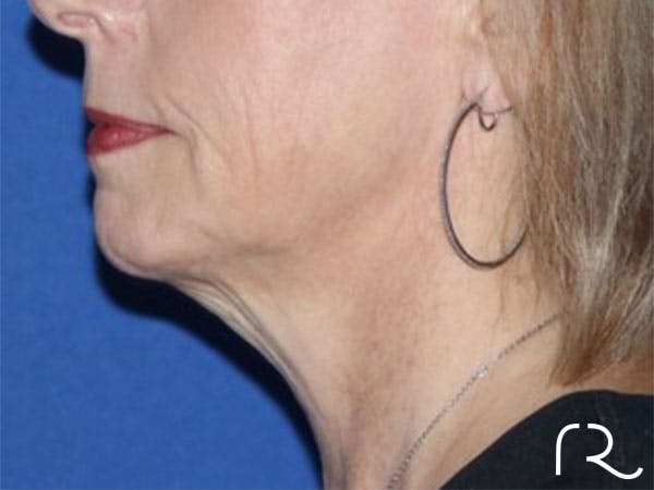 Extended Deep Neck Lift Before & After Gallery - Patient 146377528 - Image 1