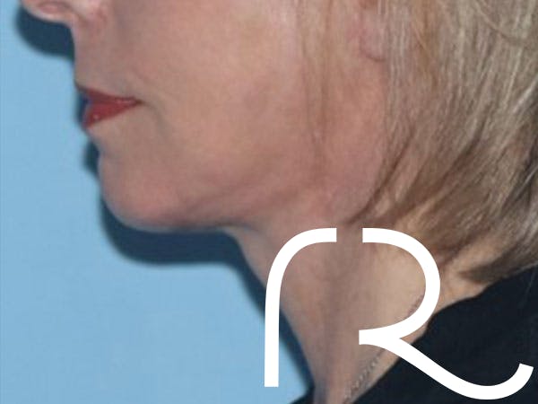 procedure