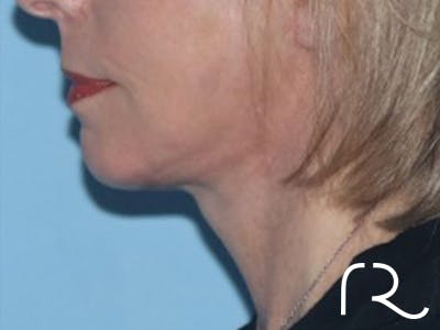 Extended Deep Neck Lift Before & After Gallery - Patient 146377528 - Image 2