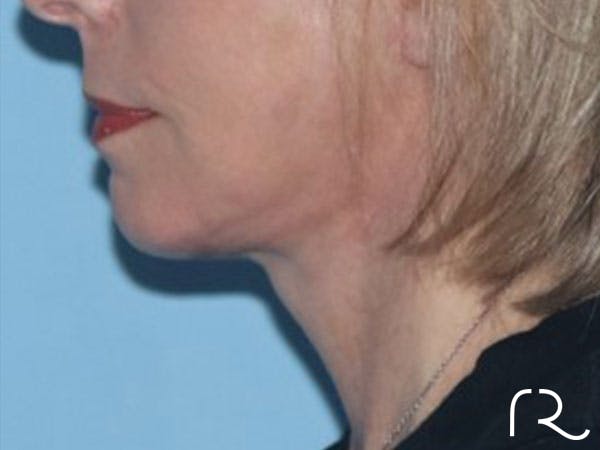 Extended Deep Neck Lift Before & After Gallery - Patient 146377528 - Image 2
