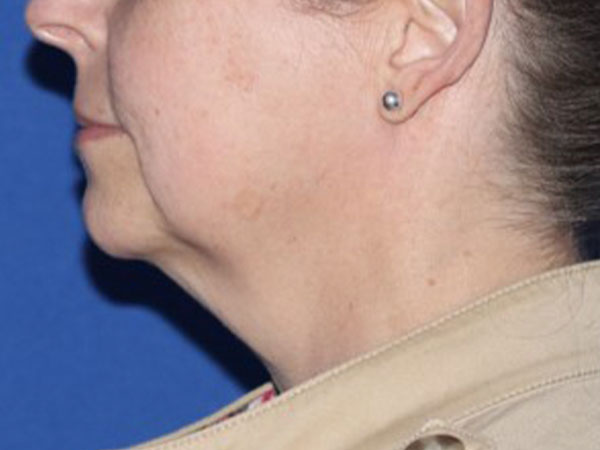 R2 Extended Deep Neck Lift Before & After Gallery - Patient 146377529 - Image 1