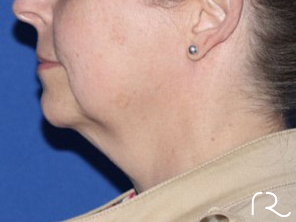 Extended Deep Neck Lift Before & After Gallery - Patient 146377529 - Image 1