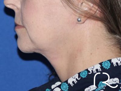 Extended Deep Neck Lift Before & After Gallery - Patient 146377529 - Image 2