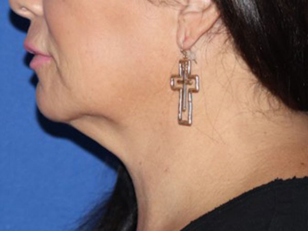 R2 Extended Deep Neck Lift Before & After Gallery - Patient 146377530 - Image 1