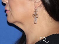 Extended Deep Neck Lift Before & After Gallery - Patient 146377530 - Image 1